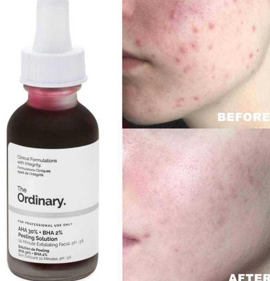 The Ordinary سرم پیلینگ لایه بردار قوی AHA30% - تصویر 3